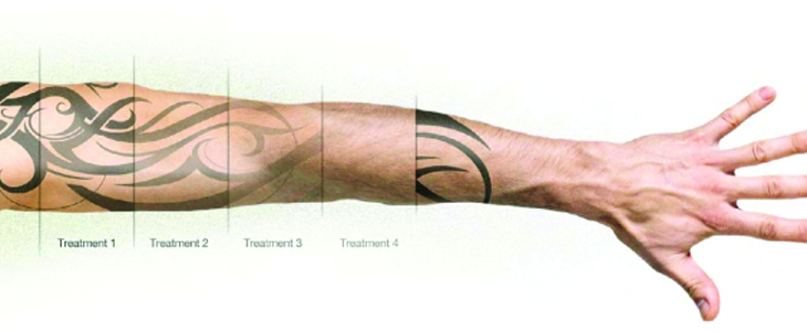 PIQo4 Laser: Everything You Need To Know - Trillium Creek Dermatology
