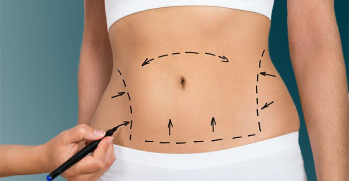 Tummy Tuck