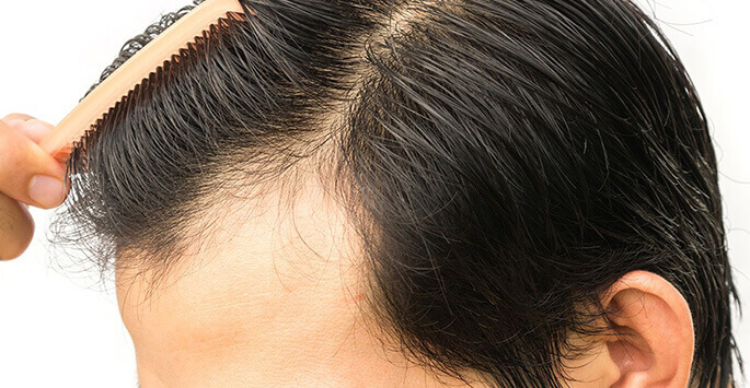 10 Things to Consider Before Going for Hair Transplant
