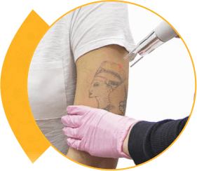 Tattoo Removal Treatment - Tattoo Removal Laser Treatment