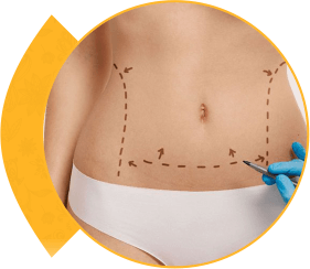 Tummy Tuck Or Abdominoplasty