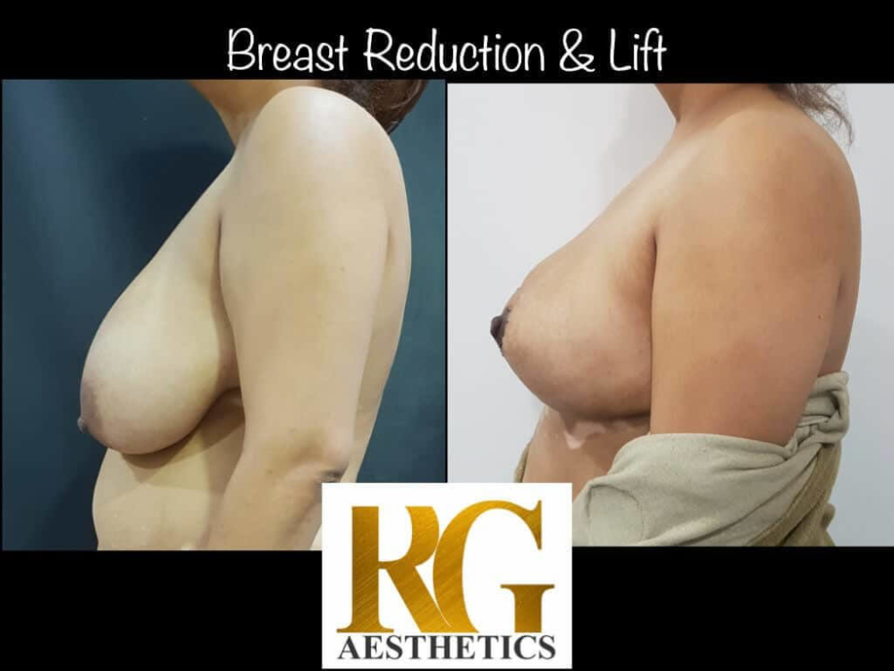 Breast Reduction