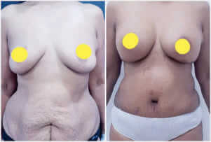 Breast Augmentation