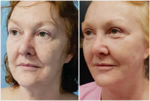 Face Neck Lift