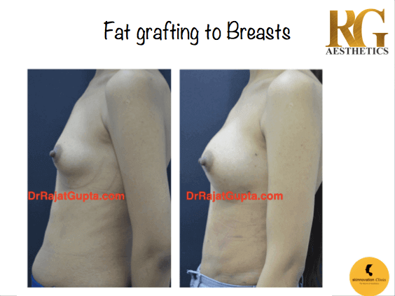 Fat Grafting in Delhi, Fat Transfer Surgery