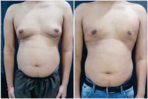 Gynecomastia