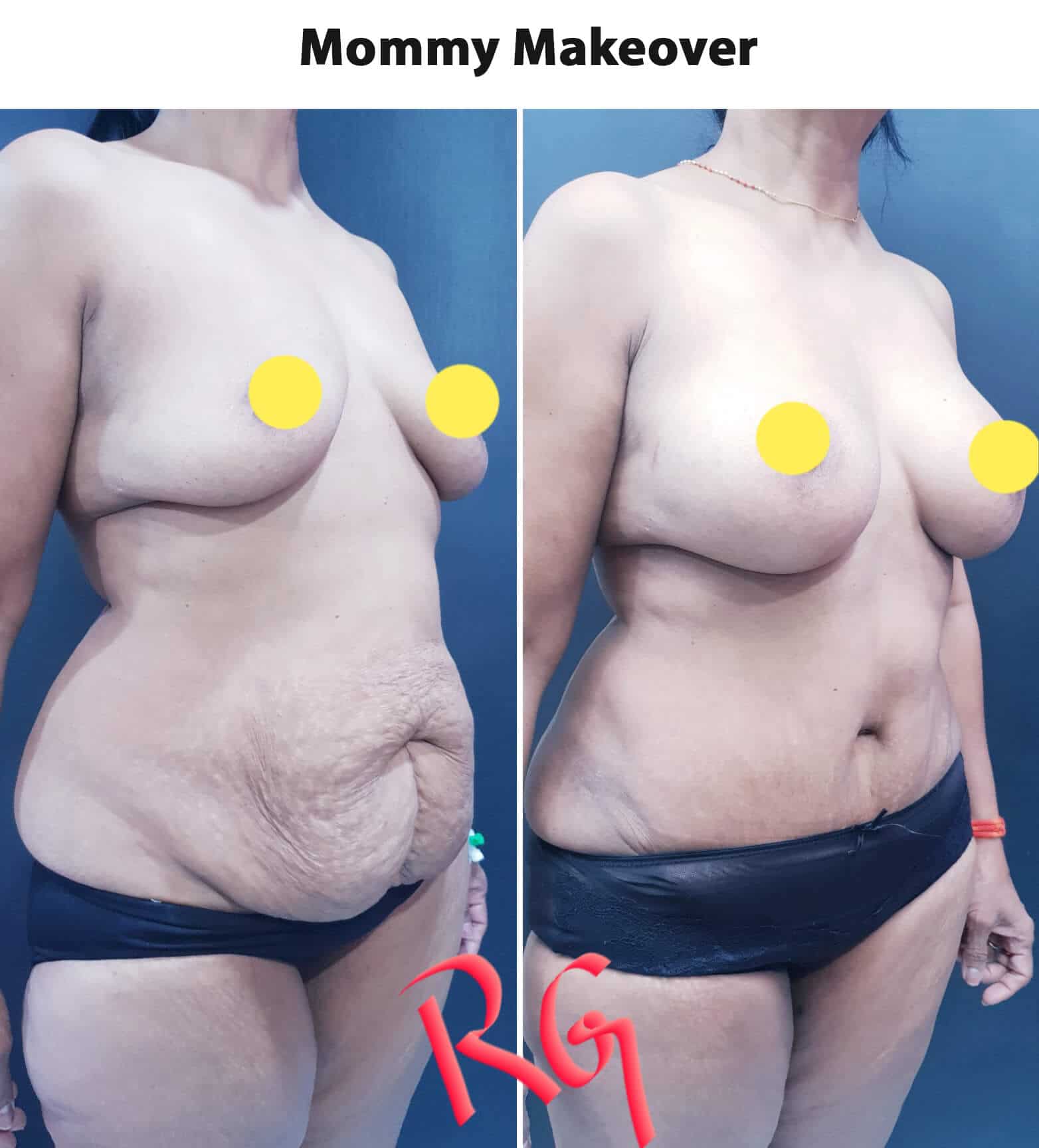 Tummy Tuck Surgery in Delhi, Tummy Tuck/Abdominoplasty Clinic