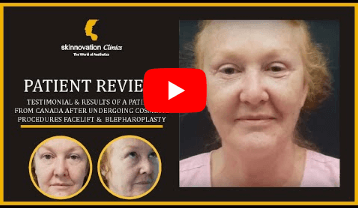 Patient Review - Blepharoplasty 01