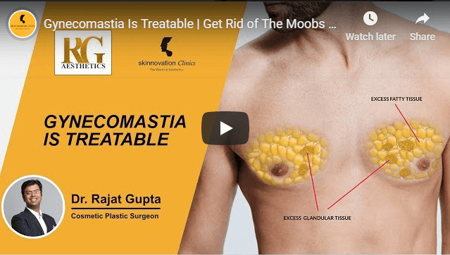 Gynecomastia Surgery